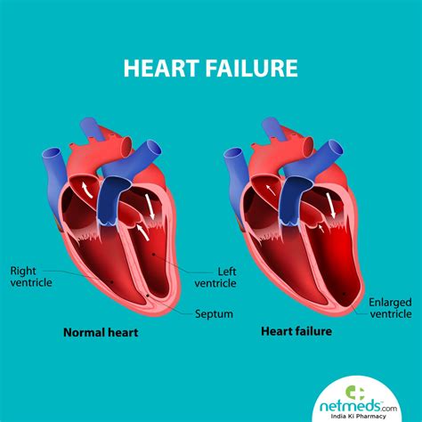 left ventricular dysfunction treatment.